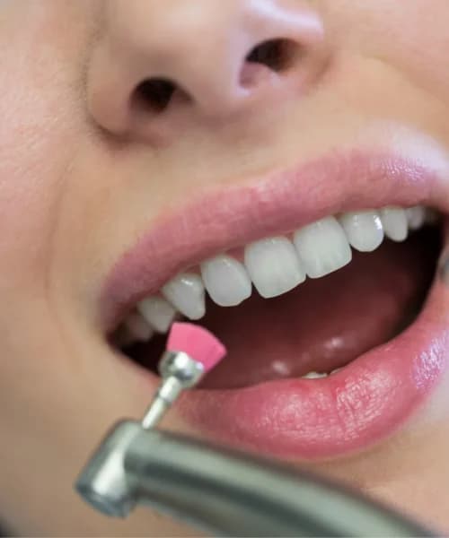 Cosmetic Bonding