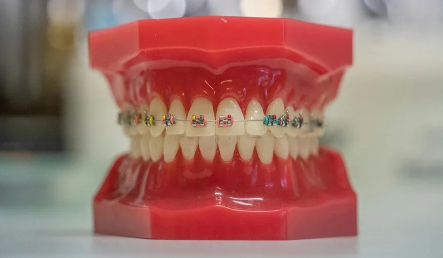 dental braces